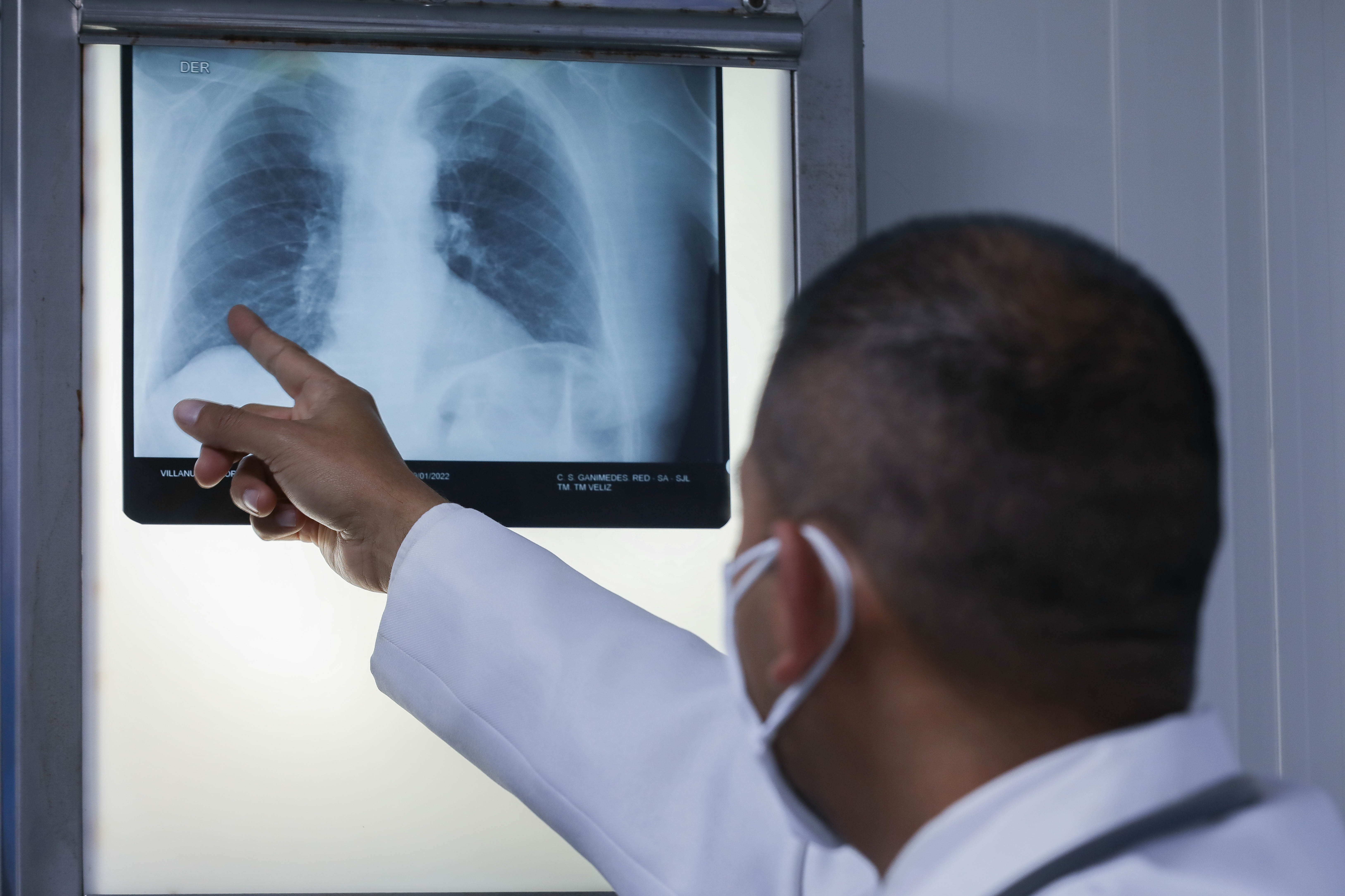 Essalud - EsSalud alerta que tuberculosis peritoneal causa complicaciones que pueden llevar a la muerte